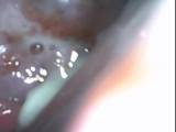 gothic-erotik -  Die Speculum-Befruchtung "Bild im Bild" Mini-Clip